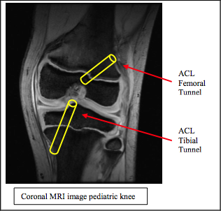 PACL-Illustration C